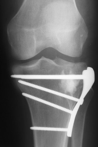 Synthes Proximal Tibial Plate (Implant 247)